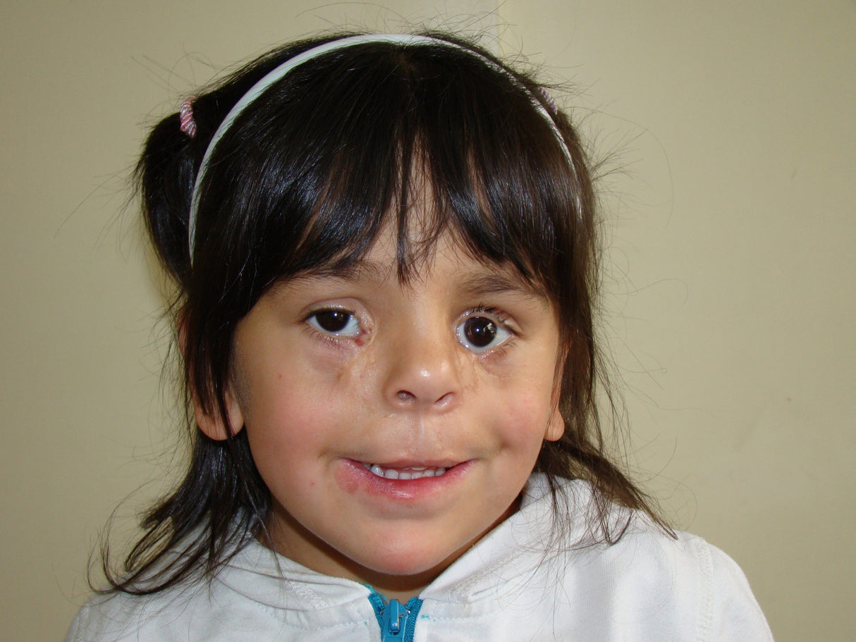 Amanda tiene 11 años y nació con dos fisuras laterales grandes y complejas en su rostro.