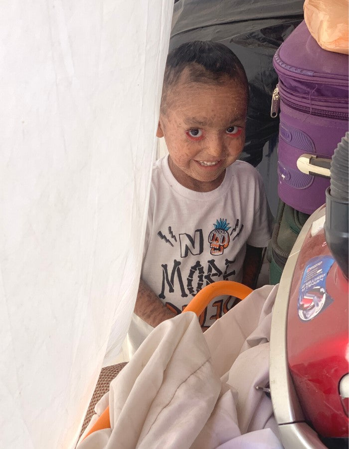 Joaquín, un niño valiente que lucha contra la Ictiosis Lamelar