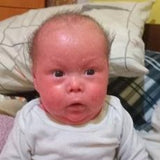 I'm Noah, I'm only 1 year old and I face a daily battle for my skin.