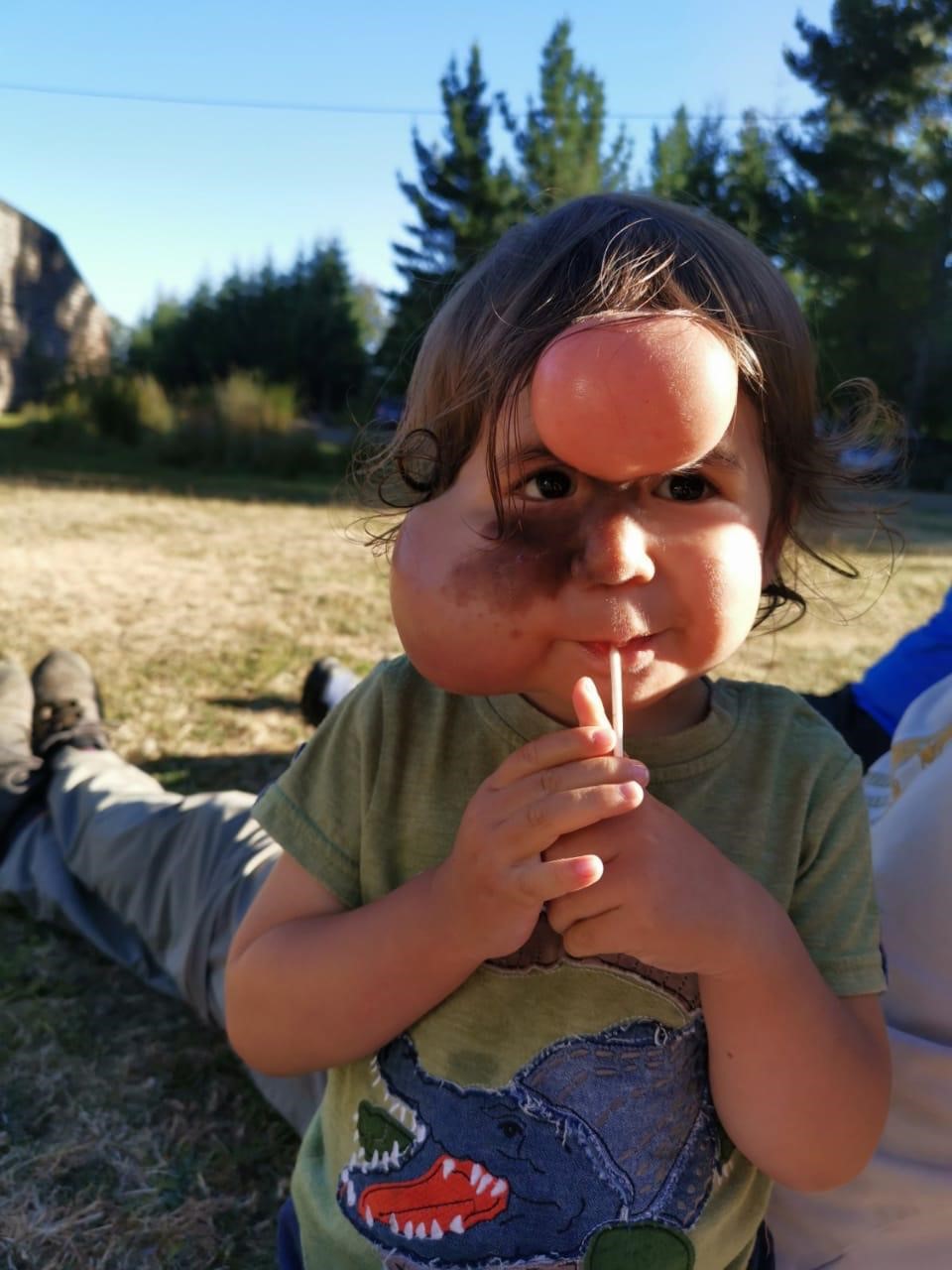 Sebastián tiene 2 años y vive con un Nevus Melanocítico gigante en su rostro.