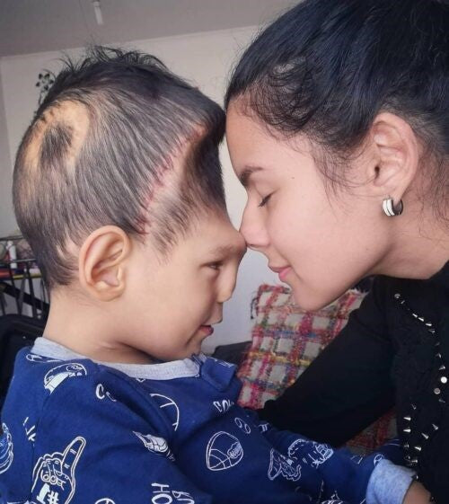 Thiago tiene 4 años y nació con múltiples malformaciones congénitas, como una malformación craneofacial e hidrocefalia